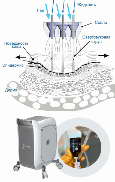 Насадка JetPeel® технологическое устройство